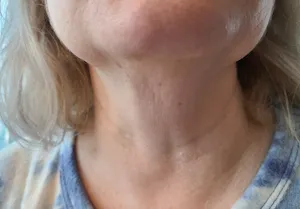 After - Neck & under-chin contour