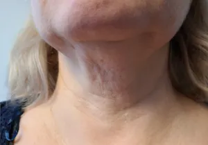 Before - Neck & under-chin contour