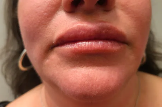 After - Lip enhancement