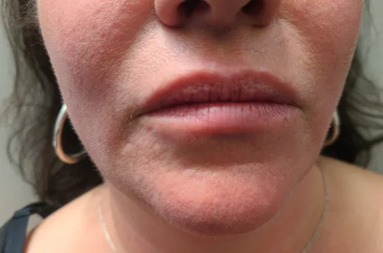 Before - Lip enhancement