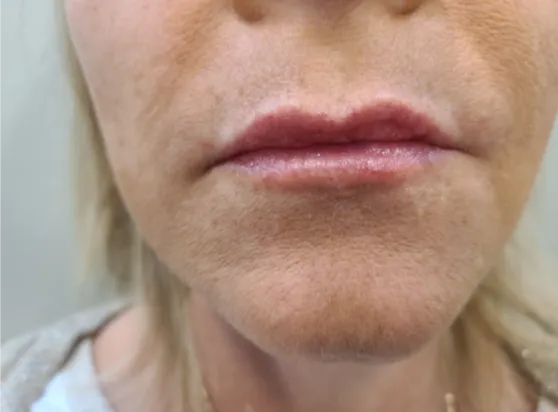 After - Lip enhancement