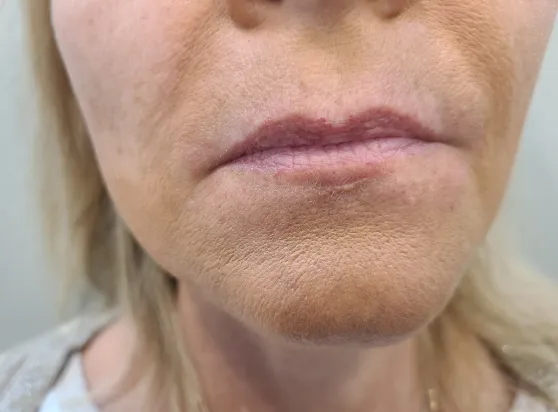 Before - Lip enhancement