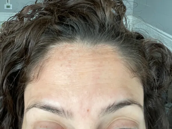 After - Forehead lines