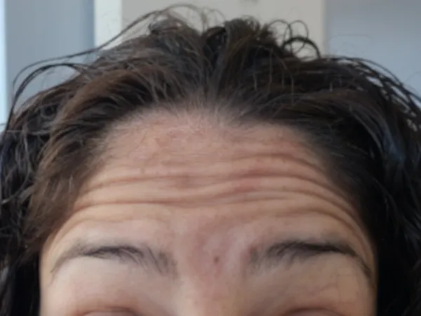 Before - Forehead lines
