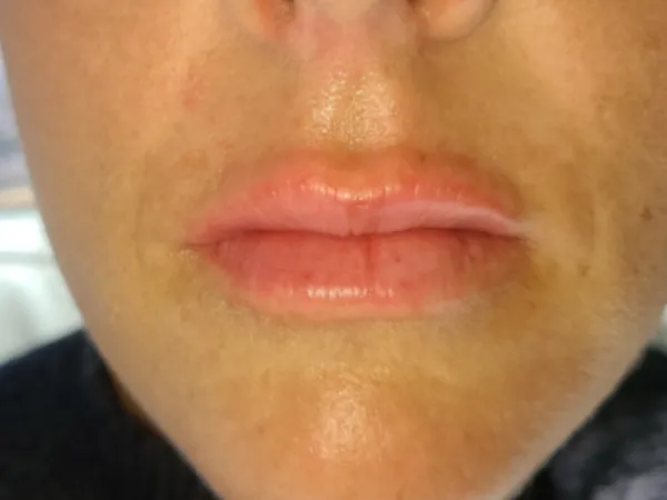 After - Lip enhancement