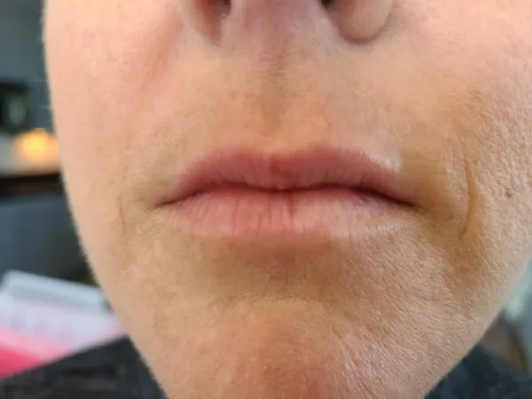 Before - Lip enhancement