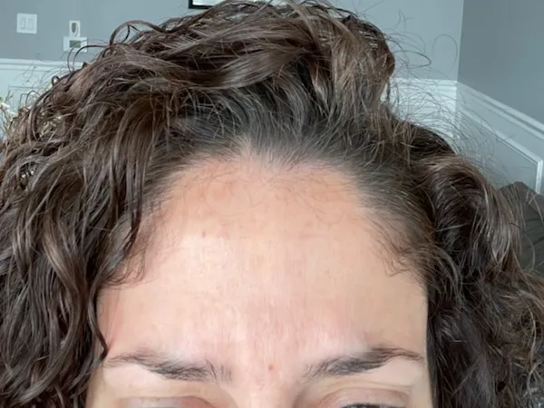 After - Frown lines
