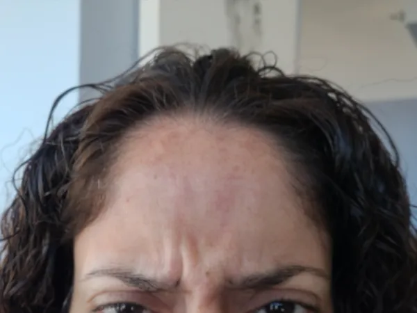 Before - Frown lines