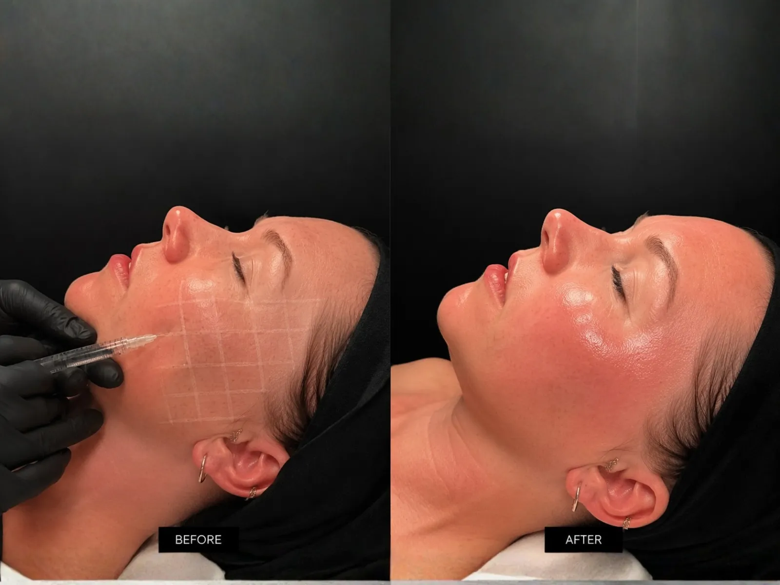 SKINVIVE by JUVÉDERM